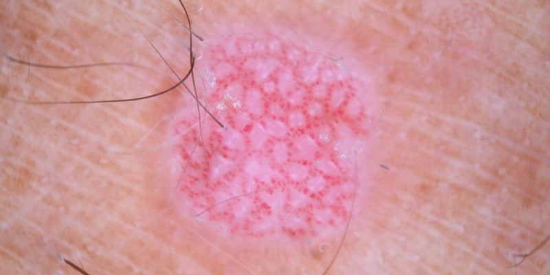 Dermoscopy for pink lesions (Nurse)