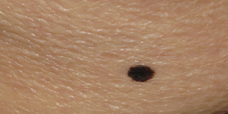 Dermoscopy for difficult benign lesions including nevi with special features (Nurse)