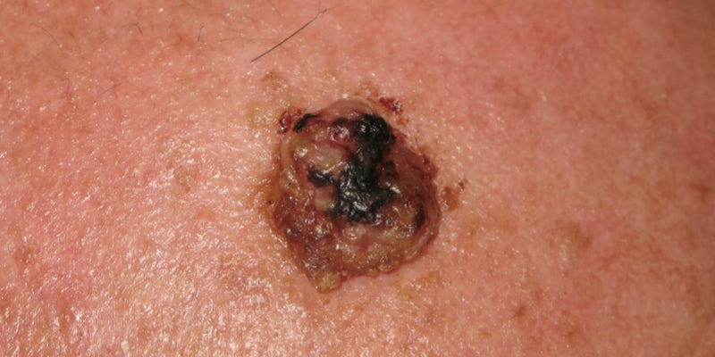 Dermoscopy for rare skin tumours (Nurse)