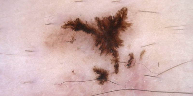 The broad spectrum of BCC and keratinocyte skin cancer (Nurse)