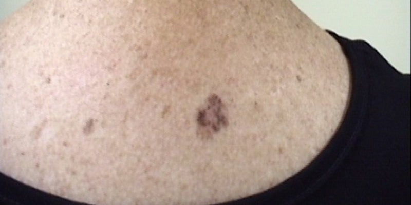 Histopathology of melanocytic lesions Part 1 (Nurse)