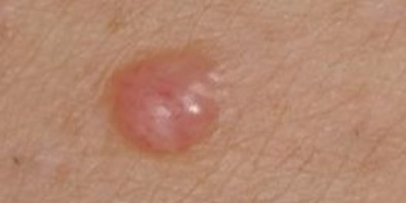 Dermoscopy for difficult melanomas (Nurse)