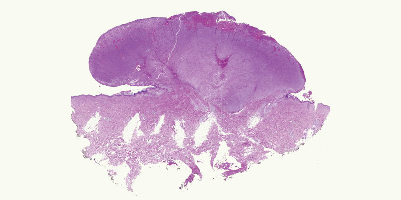 Histopathology of melanocytic lesions Part 2 (Nurse)