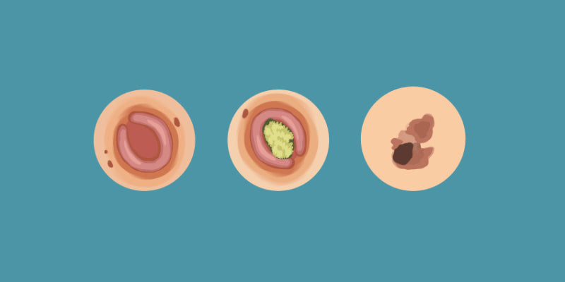 The Big Three: BCC, SCC and Melanoma (Nurse)