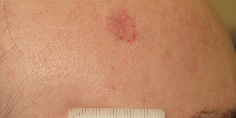 Dermoscopy for the management of non-melanoma skin cancer (Nurse)