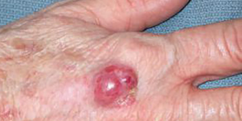 Merkel cell carcinoma and rare/aggressive melanoma and non-melanoma skin cancers (Nurse)