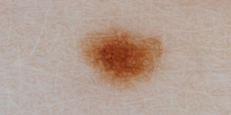 Dermoscopy for melanocytic nevi (Nurse)