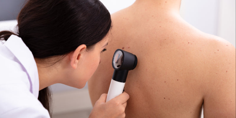 Dermoscopy for melanoma (Nurse)